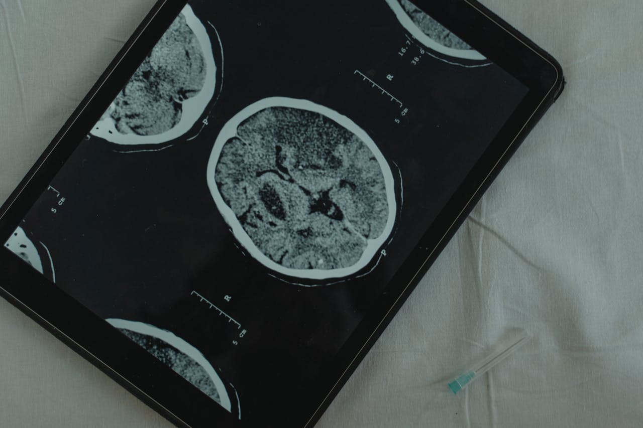 An MRI image of a brain 
